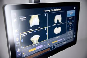 Bildschirmansicht: Planung eines Implantats. Mit Hilfe der an Oberschenkelknochen und Schienbein befestigten kleinen chirurgischen Stifte (sog. Tracker) erfasst das Robotiksystem das individuelle Modell des Kniegelenks. Bildschirmansicht: Planung eines Implantats. Mit Hilfe der an Oberschenkelknochen und Schienbein befestigten kleinen chirurgischen Stifte (sog. Tracker) erfasst das Robotiksystem das individuelle Modell des Kniegelenks. So kann die korrekte Größe und Position für das Implantat ermittelt werden.